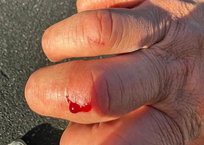 Greg Gastelum shows his cut finger he recieved from his Tesla Cybertruck